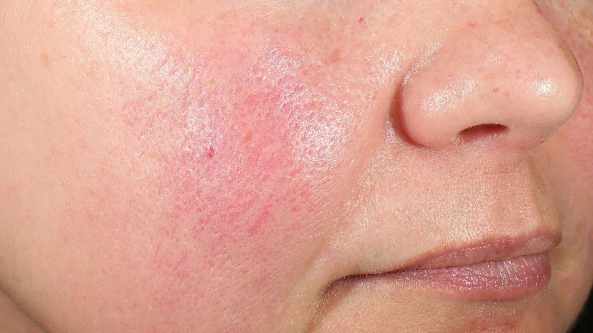 Signs Your Skin Barrier Is Damaged (and What to Do About It)